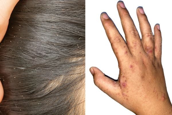 Side by side scabies on head and hand