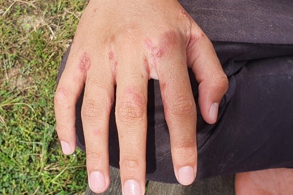 Scabies on hand