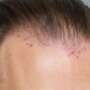 Hair Transplant Turkey Cost – Experience Transparency in Hair Transplant Price